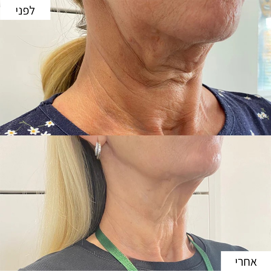 NeckRevive – הסוד למיצוק והצערת עור הצוואר